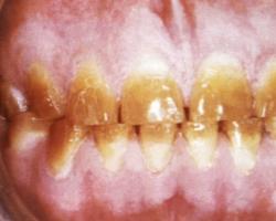 Как отбелить тетрациклиновые зубы максимально эффективно и бережно?