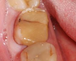 Дырка в зубе и пустота Интересное видео: препарирование и реставрация зуба при глубоком кариесе