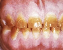 Как отбелить тетрациклиновые зубы максимально эффективно и бережно?