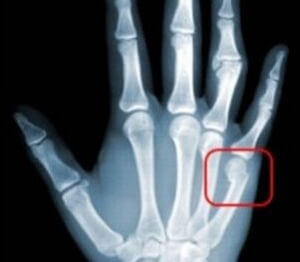 Перелом большого пальца руки: симптомы и лечение
