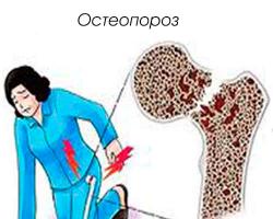 Остеопороз: симптомы и лечение